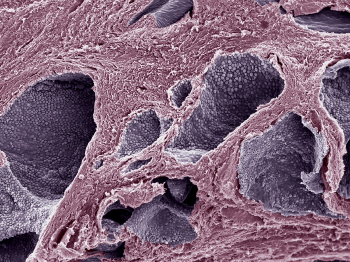 BRCA-2
