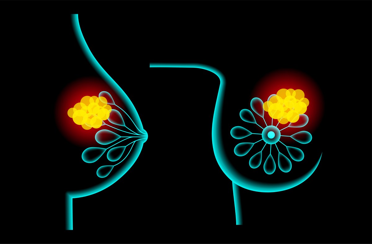 BRCA-2